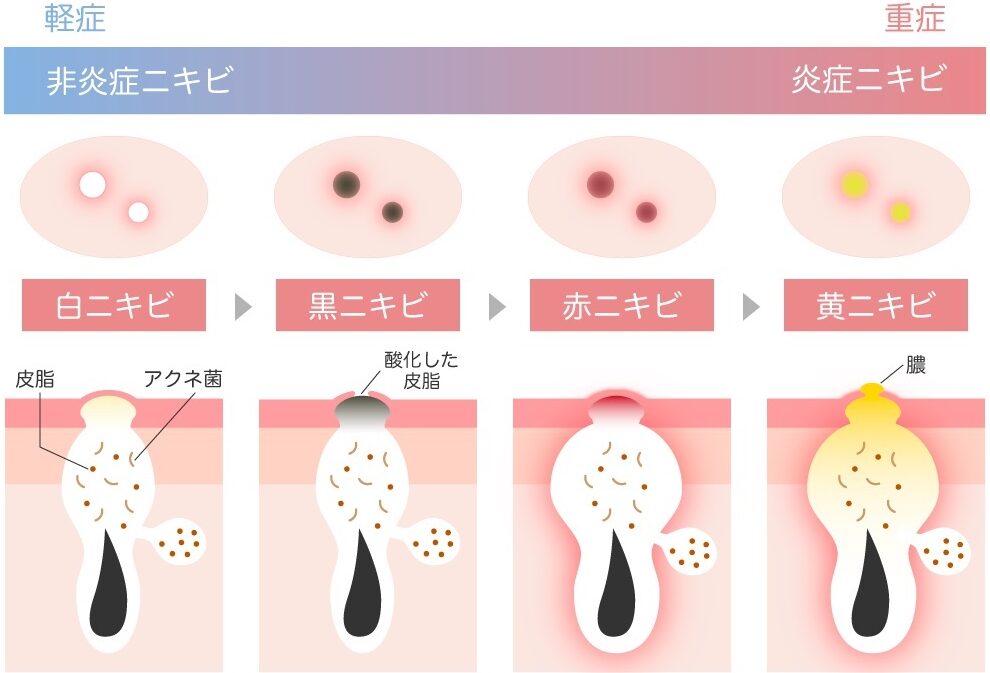 お股ニキビの原因と対策について解説しま?