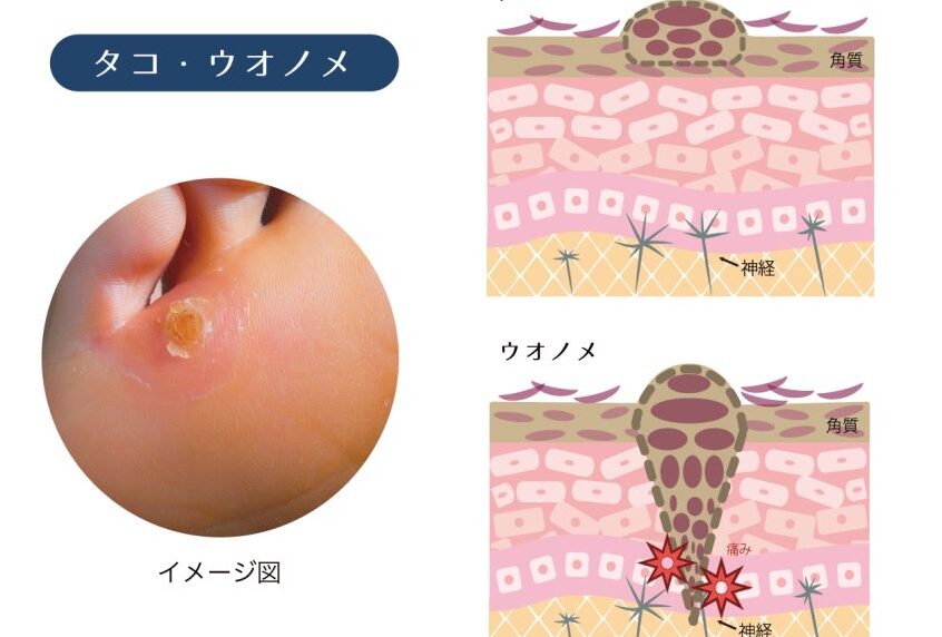 ふくらはぎ ニキビ なぜできるのか原因と対策