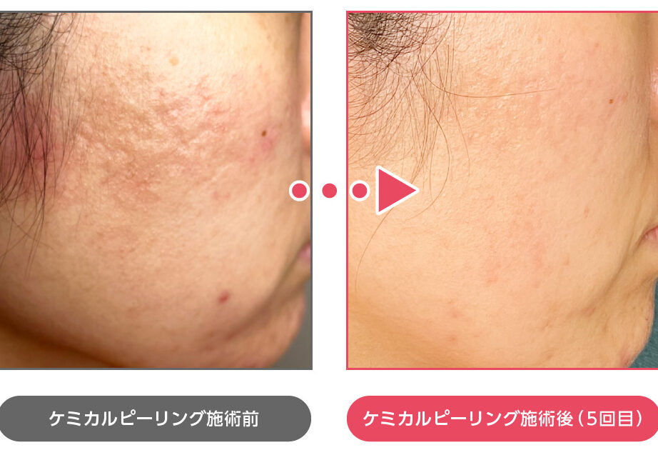 ケミカルピーリング ニキビ跡 何回の施術が必要か