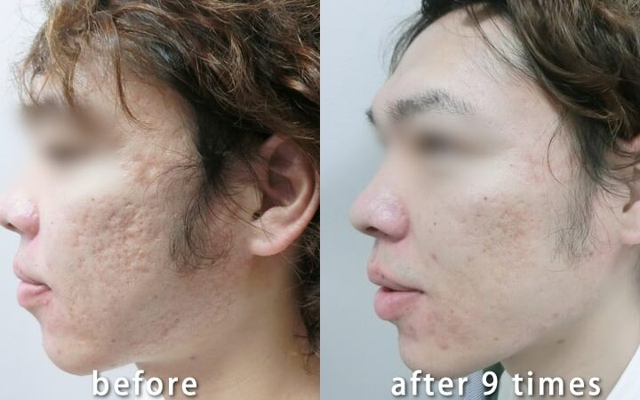 ダーマペン ニキビ跡 何回施術すれば効果があるか