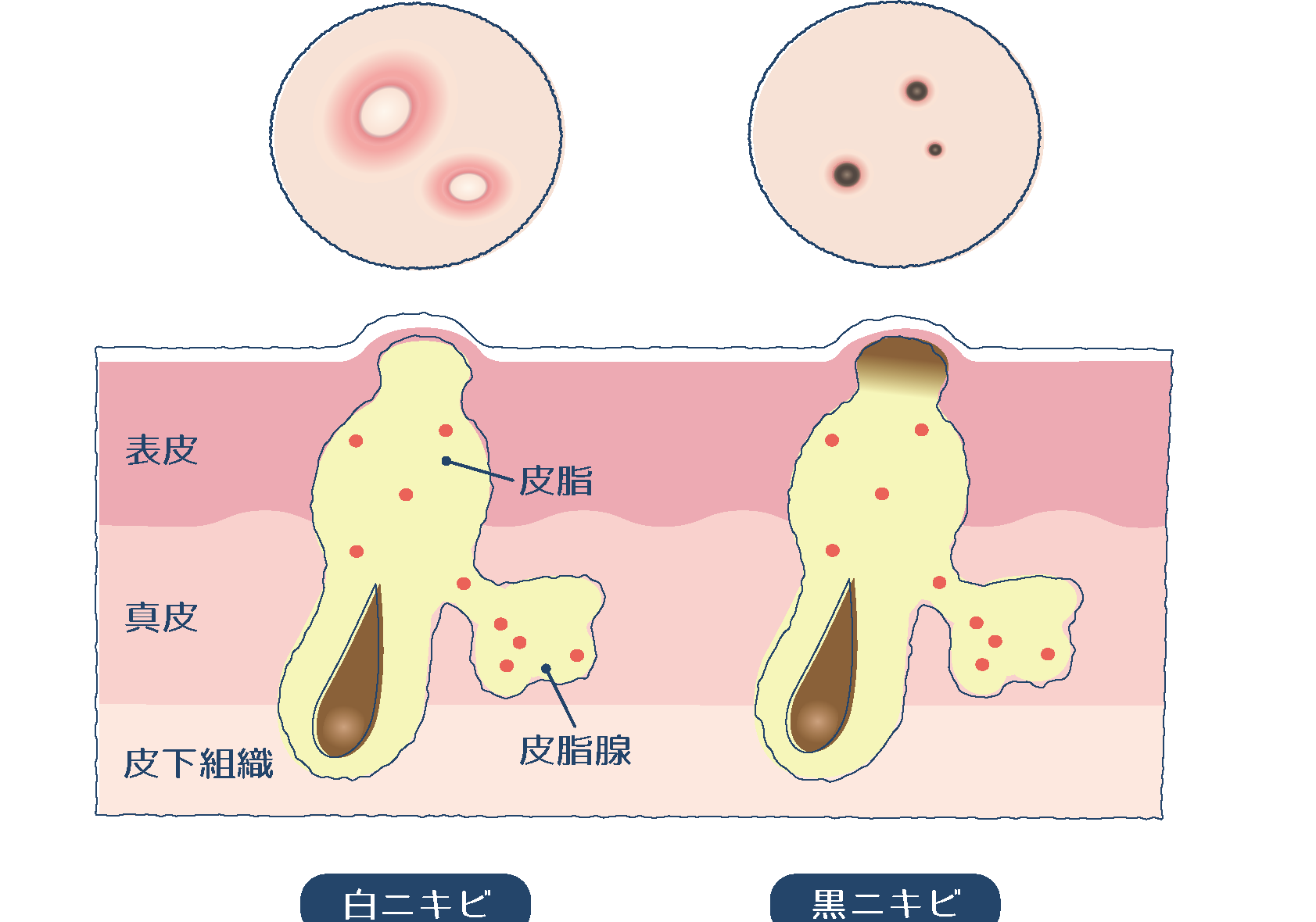 ニキビ かさぶた 何日で治るかを詳しく解説