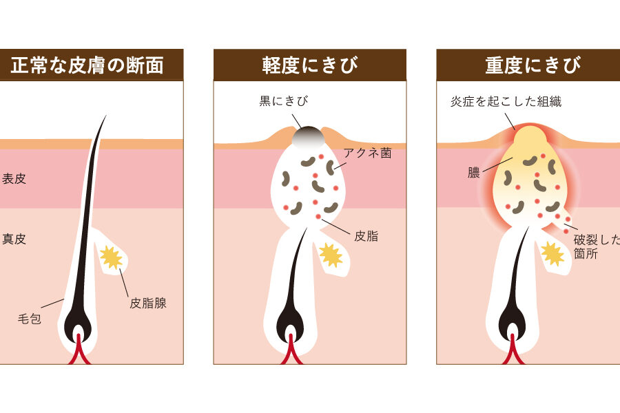 ニキビ クレーター なぜできるのか原因と対策
