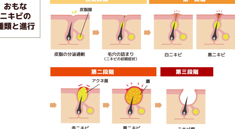 ニキビ 膿 なぜできるのか原因と対策を解説