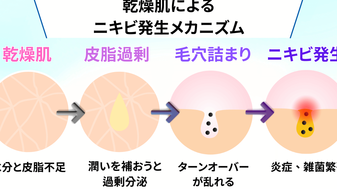 ニキビの原因は糖質と脂質どっちが影響するか