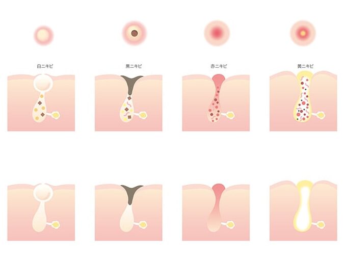ニキビの自然治癒にかかる日数とは？