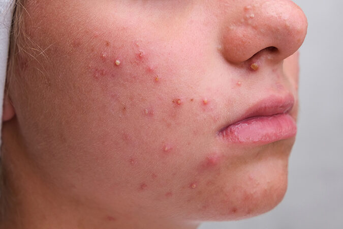 ニキビの芯とは何か？原因と対処法を解説