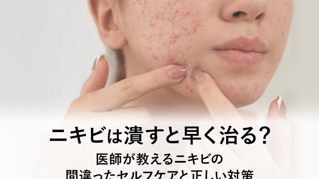 ニキビは潰した方がいい？その理由とリスクを解説