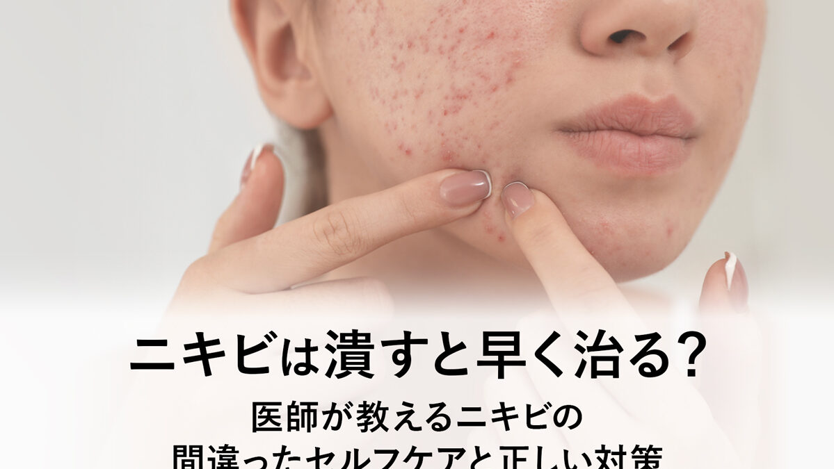 ニキビは潰した方がいい？その理由とリスクを解説