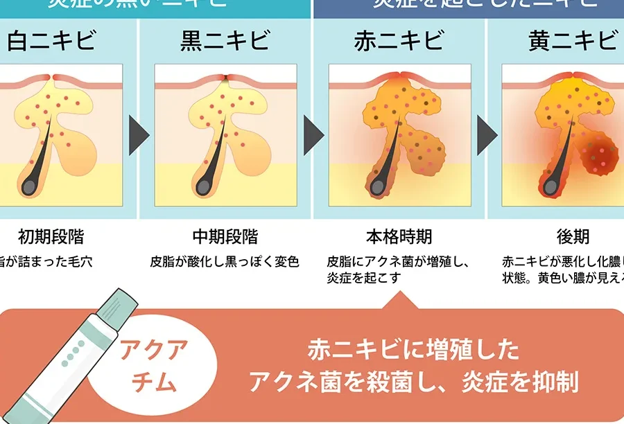 ニキビクリーム いつ塗る？効果的な使用タイミング解説