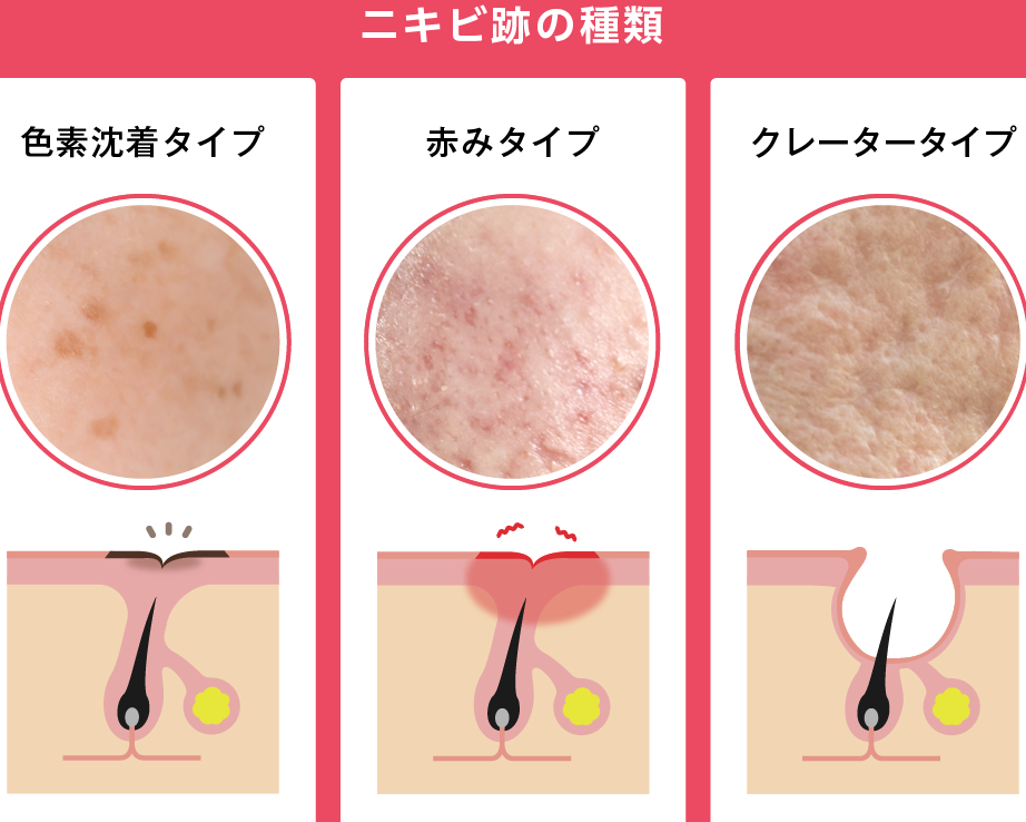 ニキビ跡 いつ治る？回復までの期間と対策方法