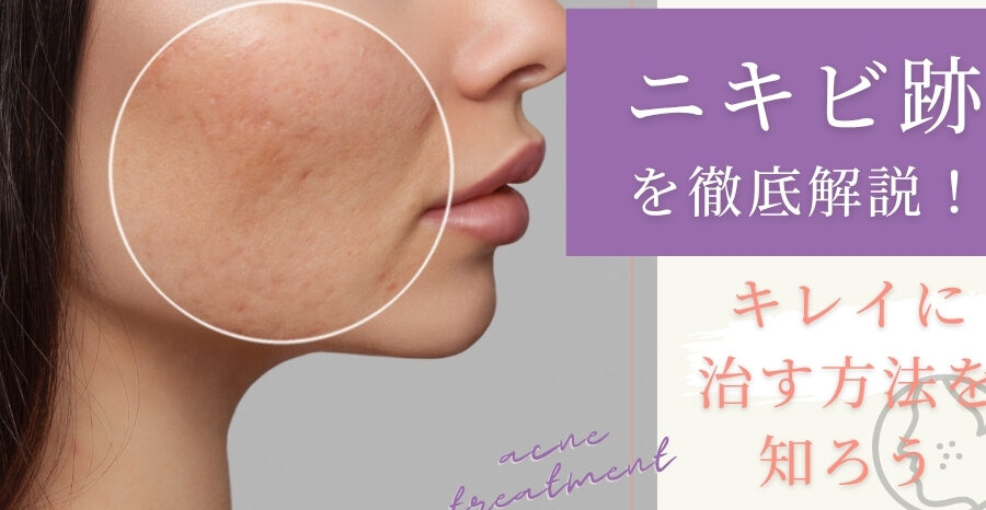 ニキビ跡 とはどのようなものかを解説する
