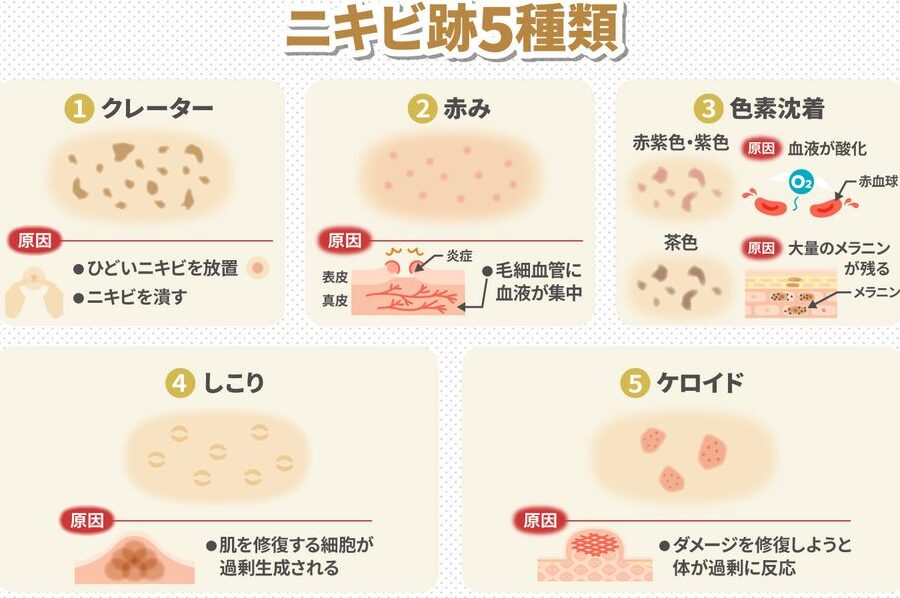ニキビ跡 なぜできるのか原因と対策を解説