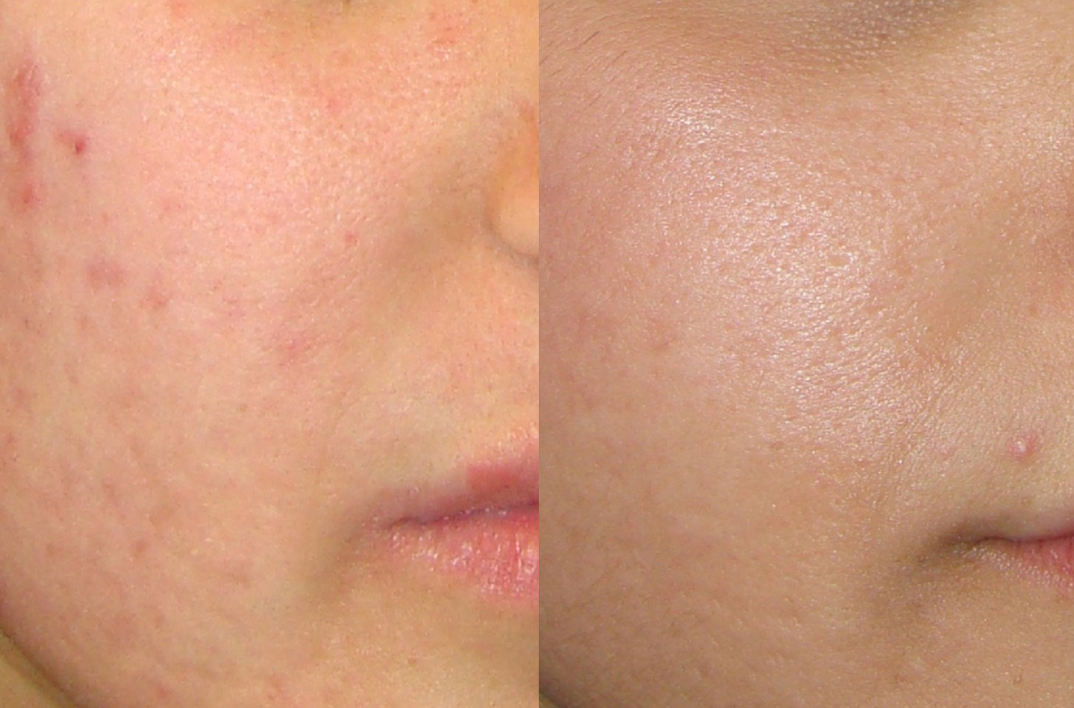 ニキビ跡 レーザー 何回で治るかを解説しま?