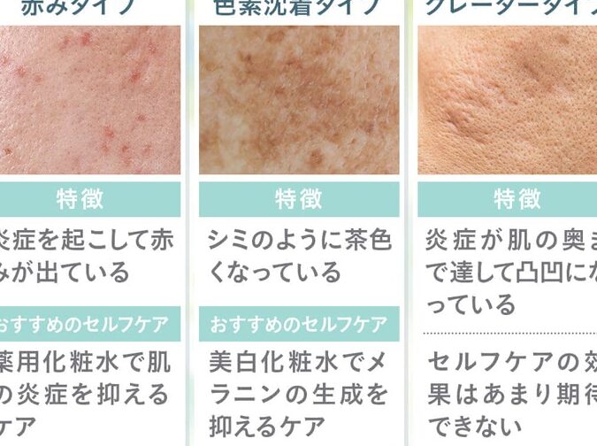 ニキビ跡 何が効く？効果的な対策と治療法を紹介