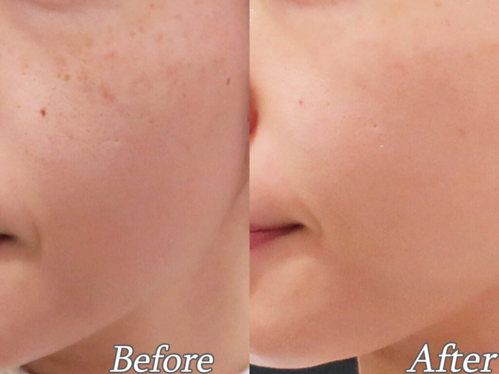 e383abe383a1e38383e382ab-e3838be382ade38393e8b7a1-e4bd95e59b9ee381a7e58ab9e69e9ce3818ce587bae3828be381aee3818be8a7a3e8aaac ルメッカ ニキビ跡 何回で効果が出るのか解説