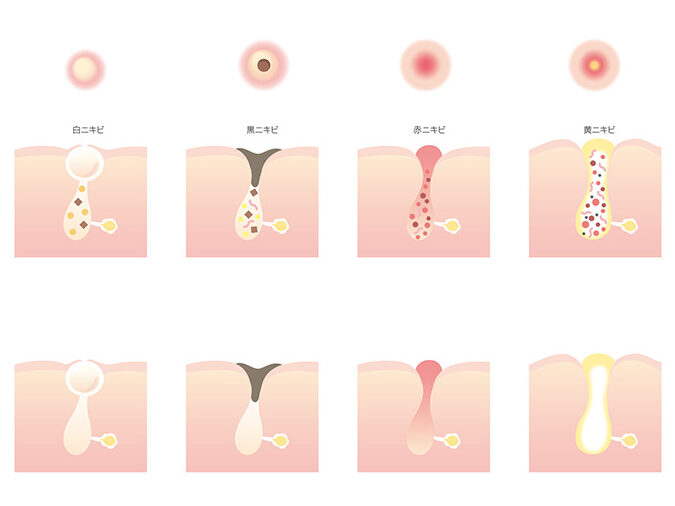 大きいニキビ 何日で治るかの詳しい解説