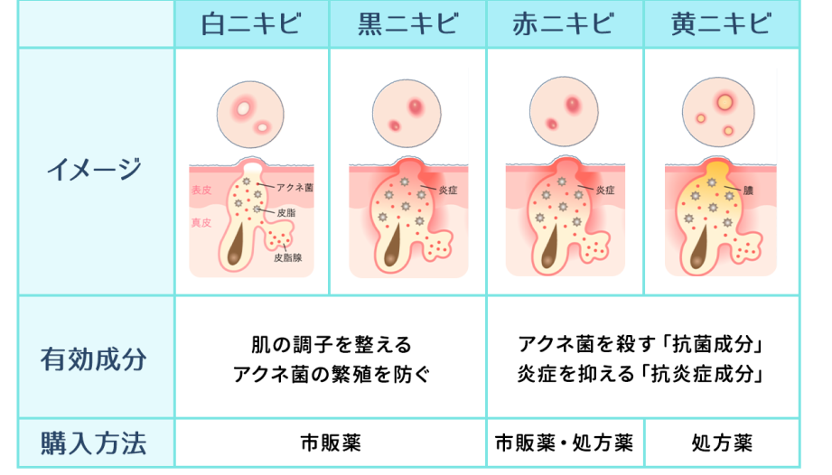 寝不足が引き起こすニキビの原因と対策はどこにある？
