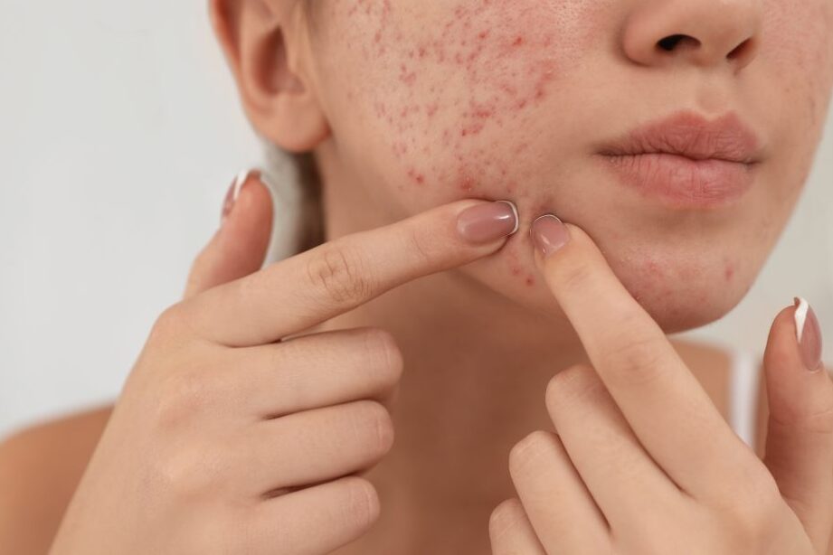 小麦 ニキビ なぜできるのかを解説しま?