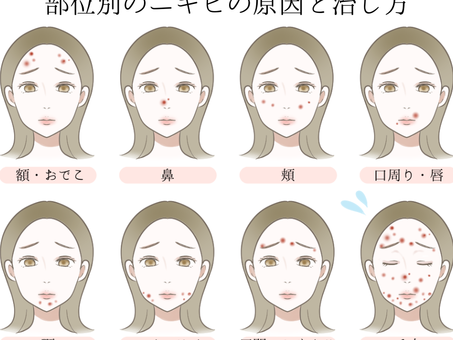 思われニキビ どこにできる原因と対策を解説