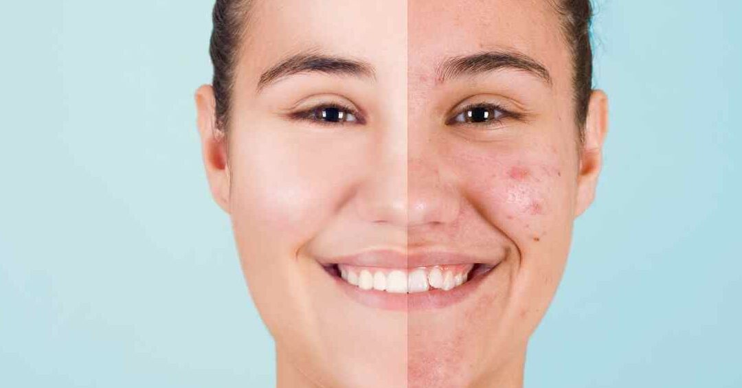 思春期ニキビ いつまで続くのかを解説しま?