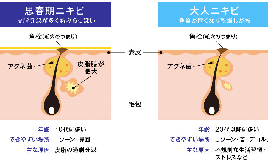 敏感肌とはニキビの原因と対策について