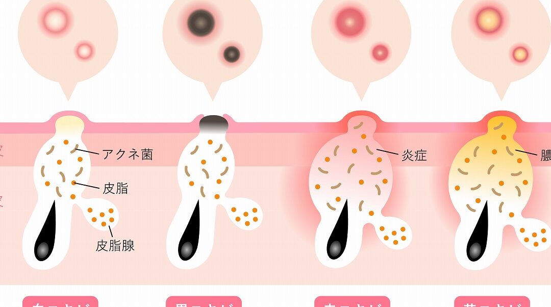 白ニキビ なぜできる原因と対策を解説しま?