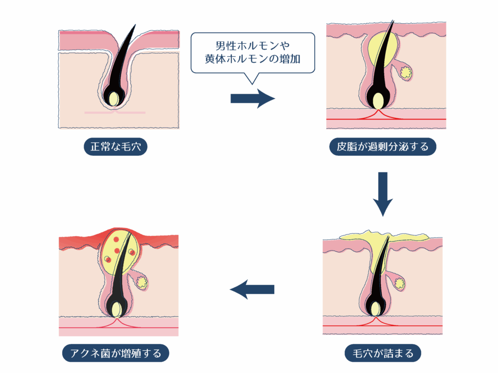 e9a0ade3838be382ade38393e381aae3819ce381a7e3818de3828be381aee3818be58e9fe59ba0e381a8e5afbee7ad96e38292e8a7a3e8aaac 頭ニキビなぜできるのか原因と対策を解説