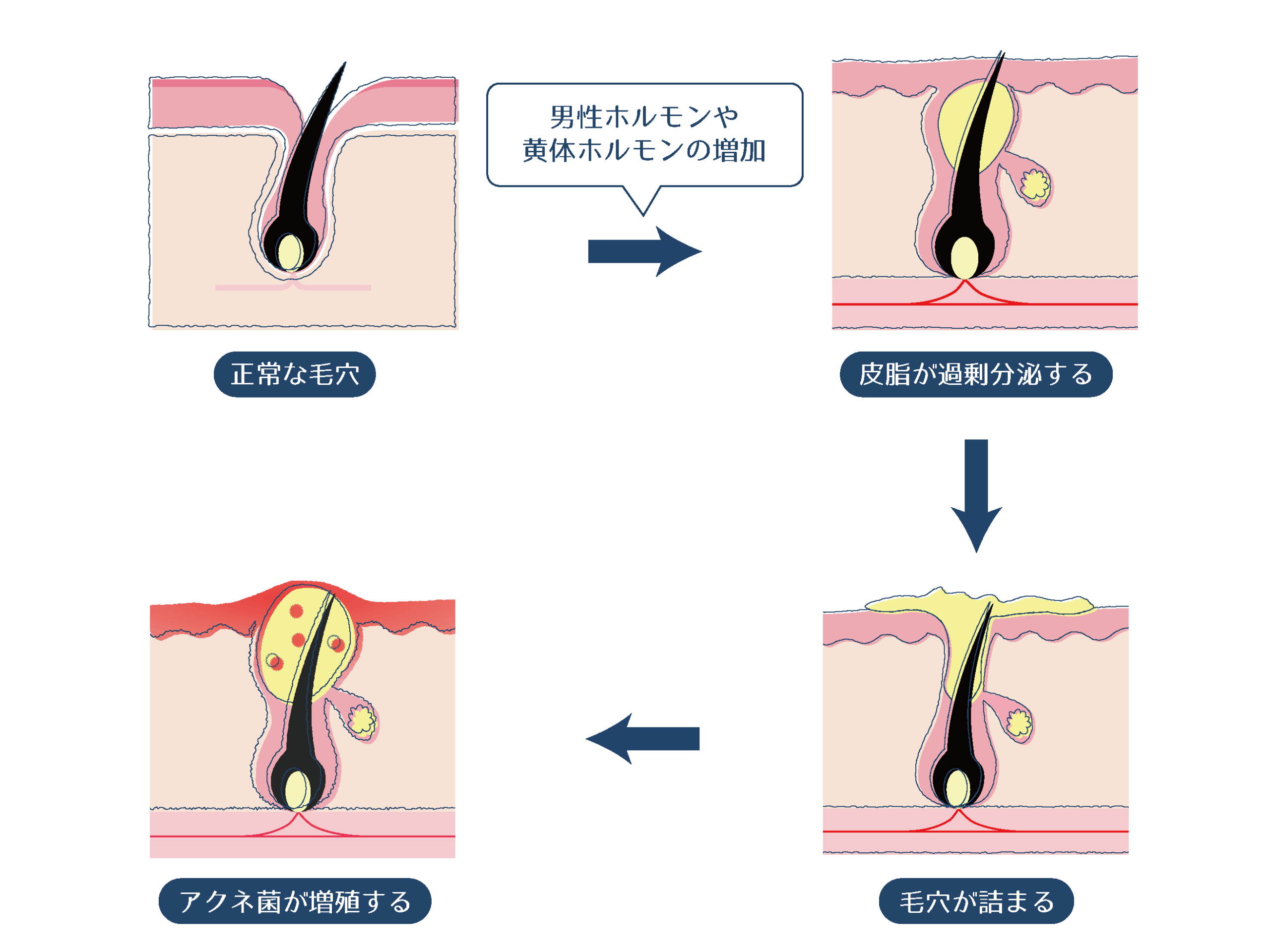 頭ニキビなぜできるのか原因と対策を解説
