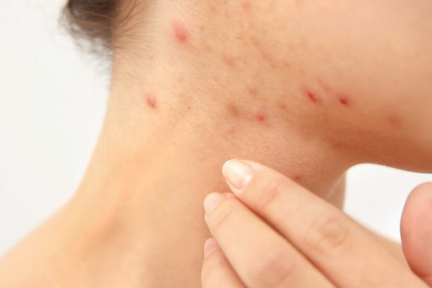 首にニキビ なぜできるのか原因と対策を解説