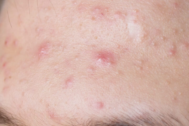 黄ニキビ 何日で治る 知恵袋の回答まとめ