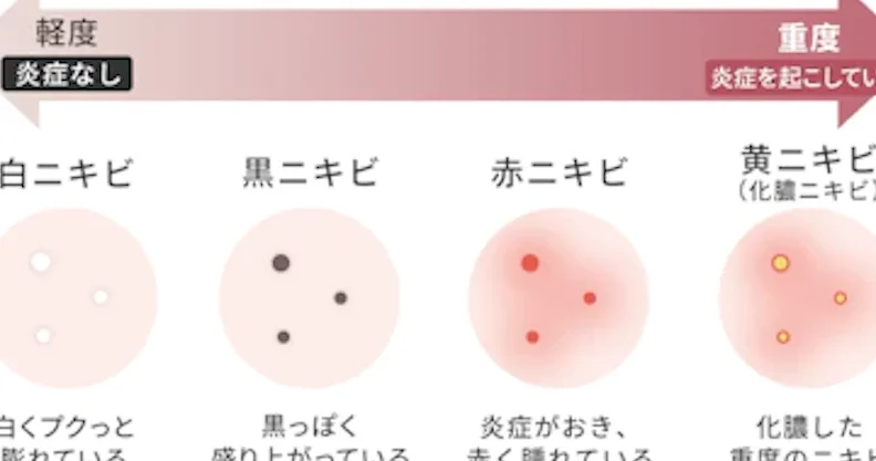 黄色ニキビ 何日で治るかの詳細と対処法